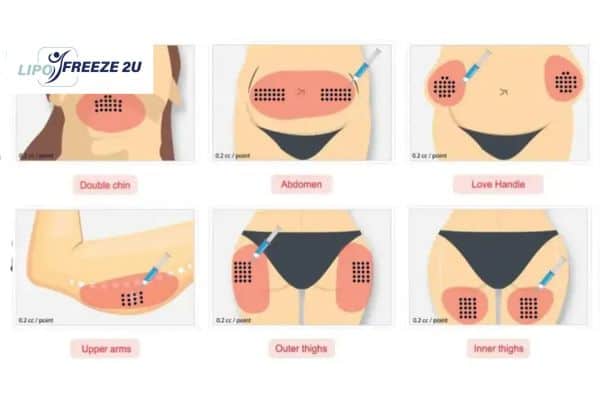 Benefits of Choosing Aqualyx for Fat Reduction Oxford