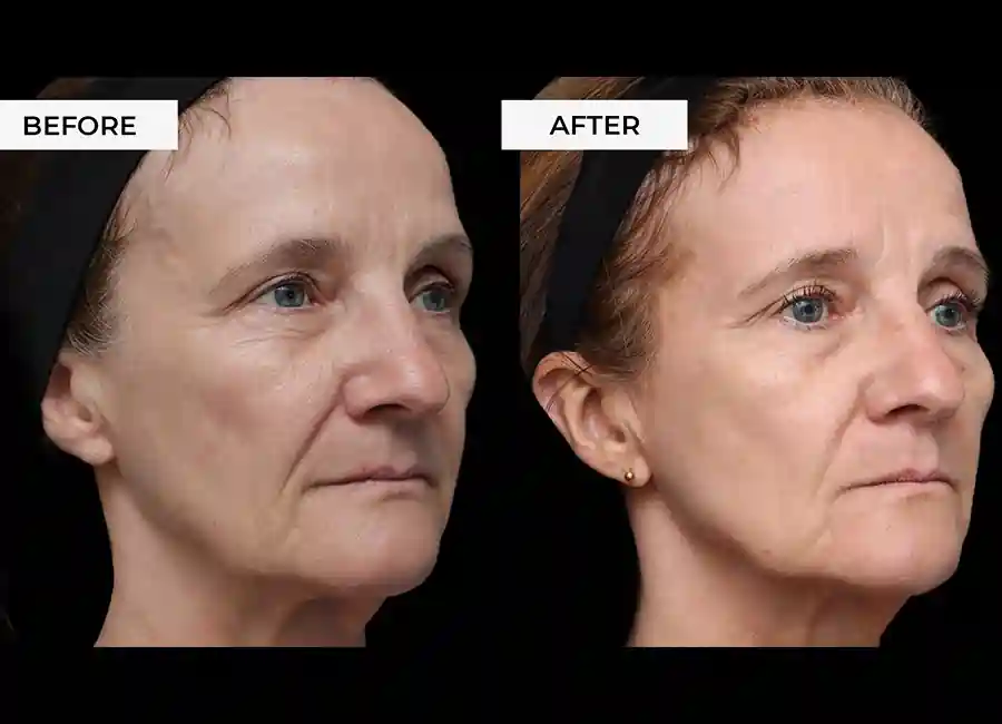 How Many RF Microneedling Sessions Will You Need to See a Difference Oxford?