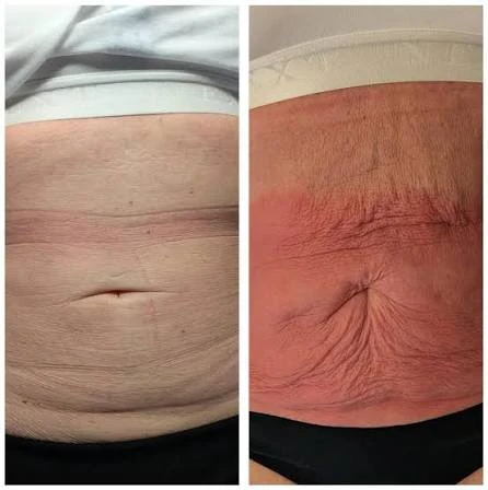How Does RF Microneedling Improve Crepey, Thin and Uneven Skin Texture Oxford?