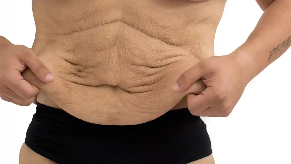RF Microneedling for Loose Skin: How Can It Help Tighten and Reshape the Skin Oxford?